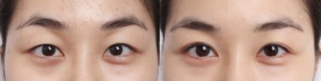 double-eyelid-surgery